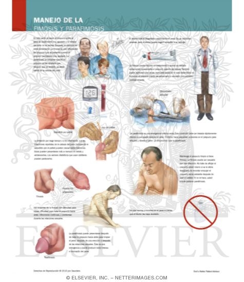 Managing Your Phimosis and Paraphimosis