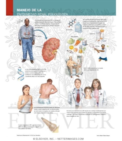 Watermarked preview of labeled image: Managing Your Polycystic Kidney Disease