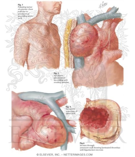 Watermarked preview of labeled image: Surgery of Aorta