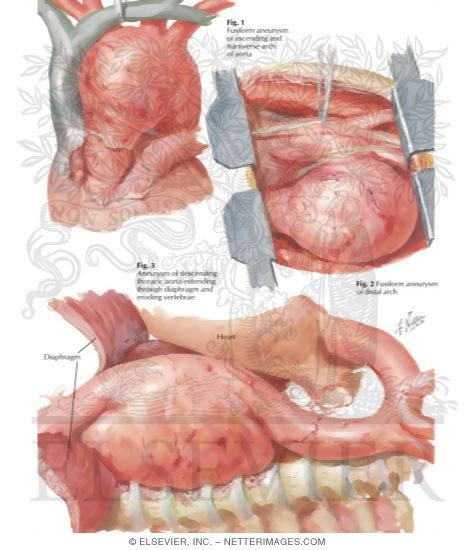 Watermarked preview of labeled image: Surgery of Aorta