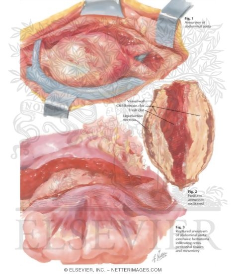 Watermarked preview of labeled image: Surgery of Aorta