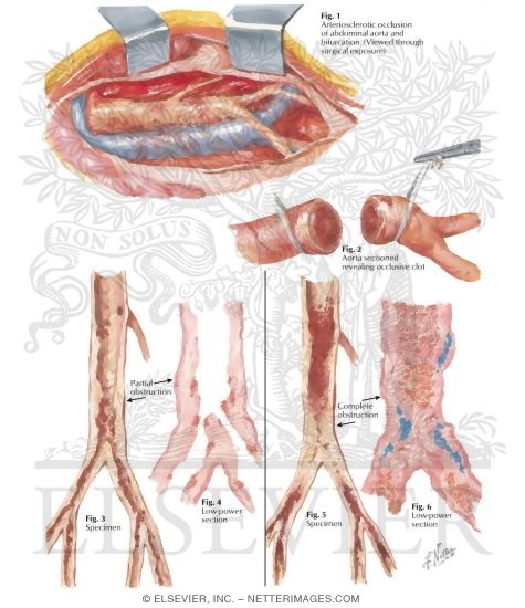 Watermarked preview of labeled image: Surgery of Aorta