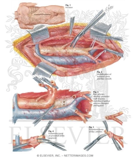 Watermarked preview of labeled image: Surgery of Aorta