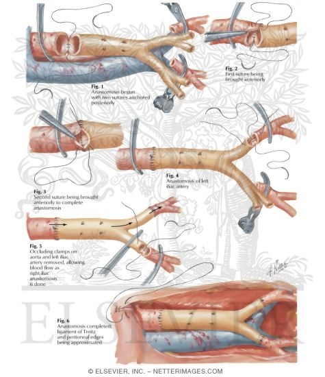 Watermarked preview of labeled image: Surgery of Aorta