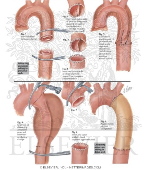 Surgery of Aorta