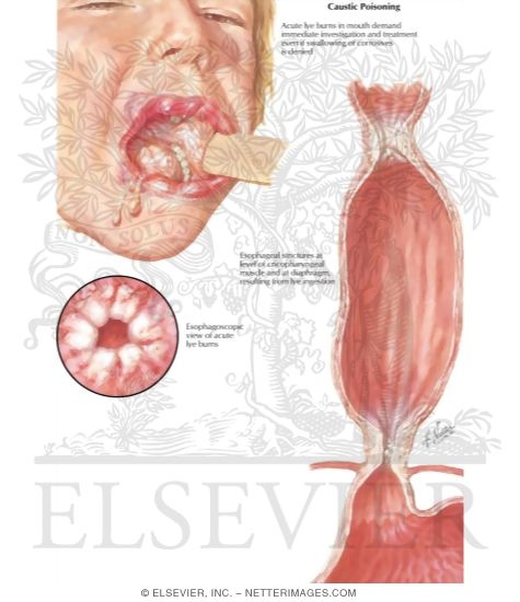 Watermarked preview of labeled image: Caustic Poisoning