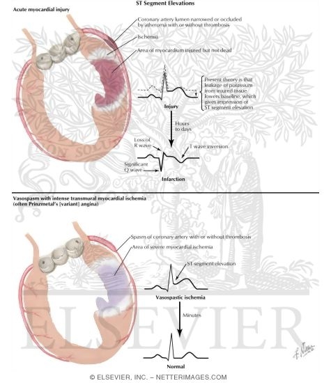 Watermarked preview of labeled image: ST Segment Elevations