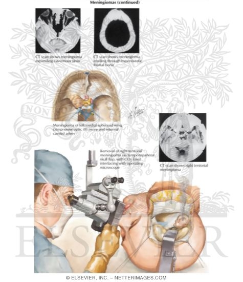 Watermarked preview of labeled image: Meningiomas