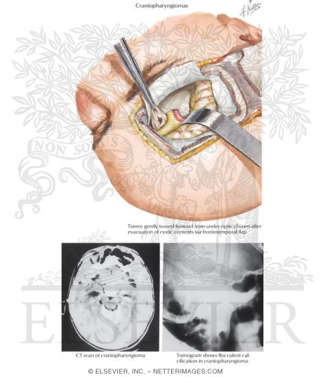 Watermarked preview of labeled image: Craniopharyngiomas