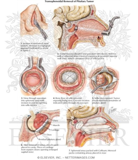 Watermarked preview of labeled image: Transsphenoidal Removal of Pituitary Tumor