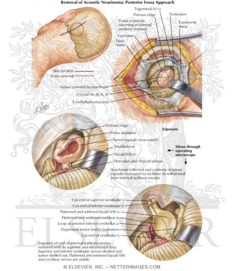 Watermarked preview of labeled image: Removal of Acoustic Neurinoma: Posterior Fossa Approach