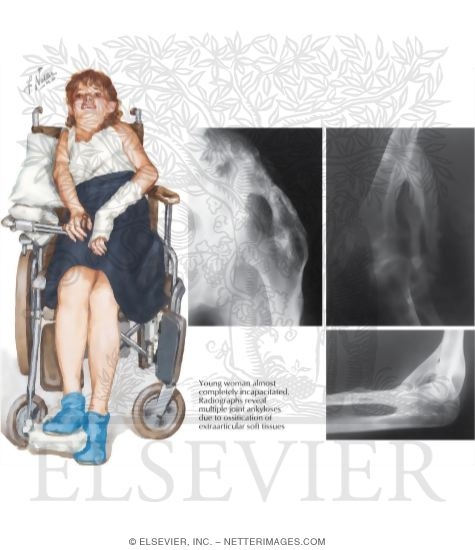 Watermarked preview of labeled image: Fibrodysplasia (Myositis) Ossificans Progressiva