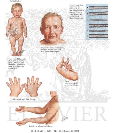 Metaphyseal Chondrodysplasias