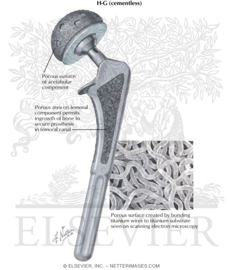 Protheses for Total Hip Replacement