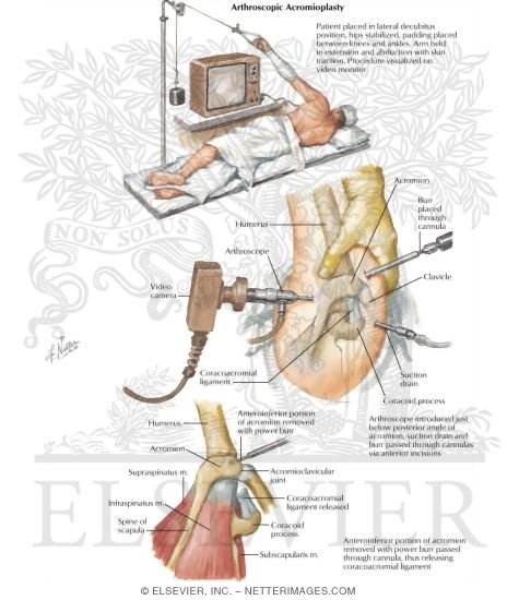 Watermarked preview of labeled image: Arthroscopic Acromioplasty