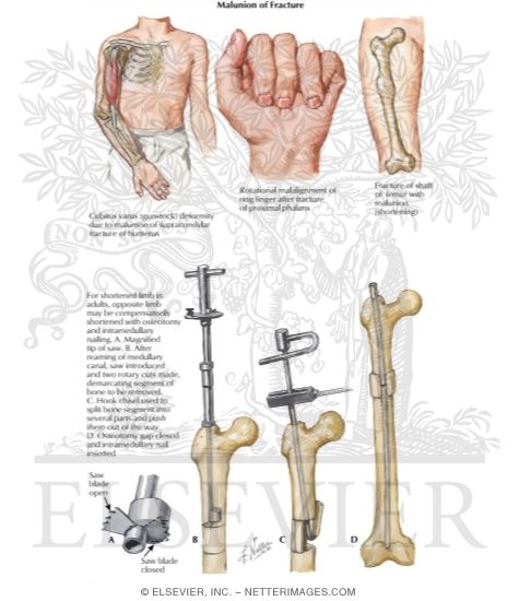 Malunion of Fracture