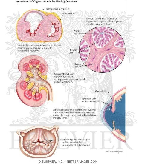 Watermarked preview of labeled image: Impairment of Organ Function by Healing Process