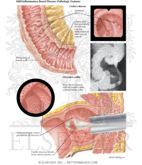inflammatory bowel disease inflammatory bowel disease