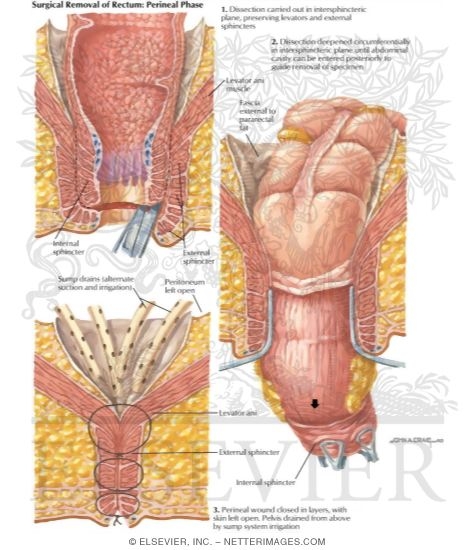 Inflammatory Bowel Disease: Surgical Removal of Rectum - Perineal Phase