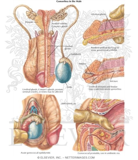 Sexually Transmitted Diseases: Gonorrhea in the Male