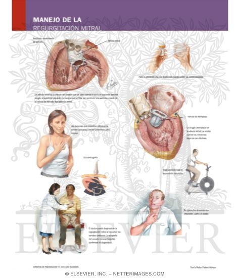 Watermarked preview of labeled image: Managing Your Mitral Regurgitation