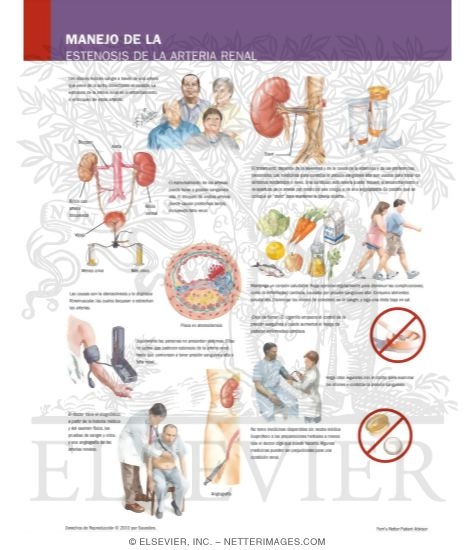 Watermarked preview of labeled image: Managing Your Renal Artery Stenosis