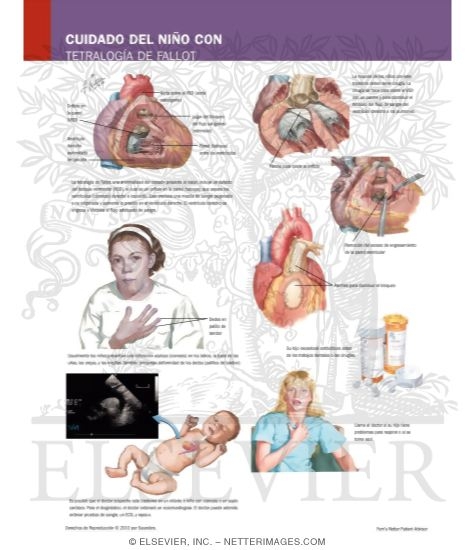 Watermarked preview of labeled image: Caring for Your Child With Tetralogy of Fallot