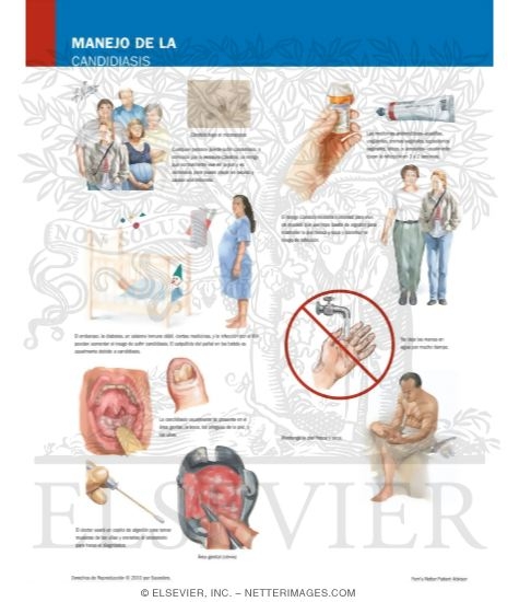 Watermarked preview of labeled image: Managing Your Candidiasis