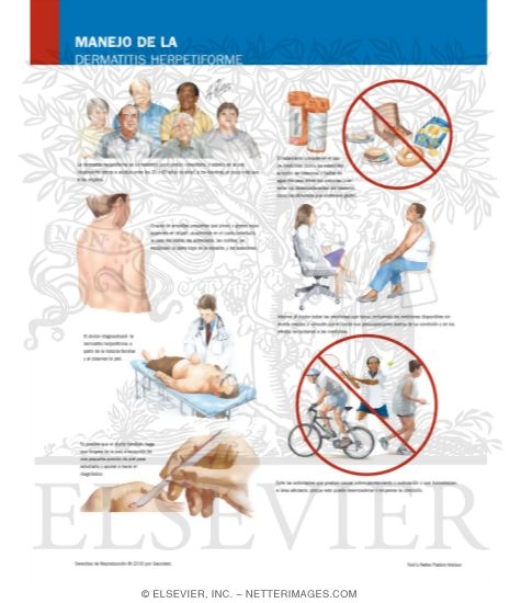 Watermarked preview of labeled image: Managing Your Dermatitis Herpetiformis