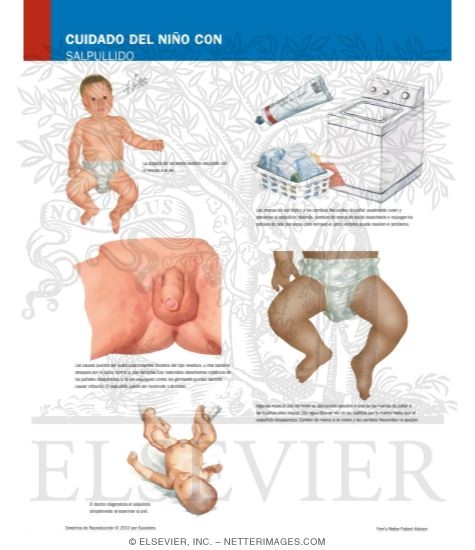 Caring for Your Baby With Diaper Rash