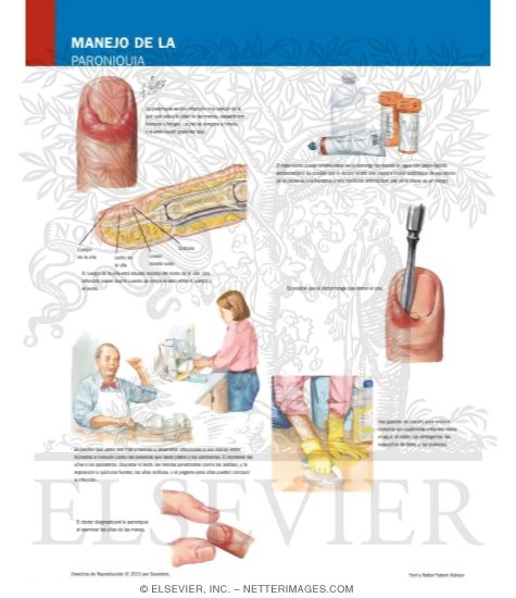 Watermarked preview of labeled image: Managing Your Paronychia