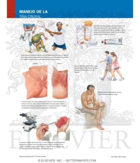 Watermarked preview of labeled image: Managing Your Tinea Cruris