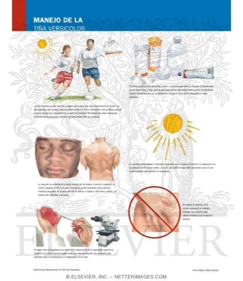Managing Your Tinea Versicolor