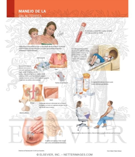 Watermarked preview of labeled image: Managing Your Galactorrhea