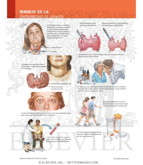 Managing Your Graves' Disease