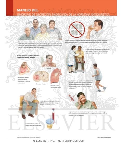 Watermarked preview of labeled image: Managing Your Syndrome of Inappropriate Secretion of Diuretic Hormone