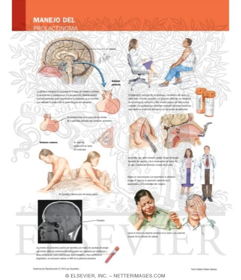Watermarked preview of labeled image: Managing Prolactinoma