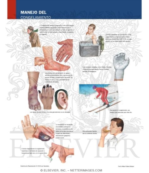 Managing Your Frostbite