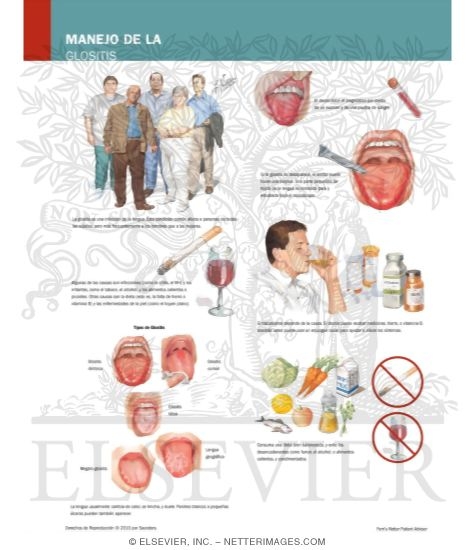 Managing Your Glossitis
