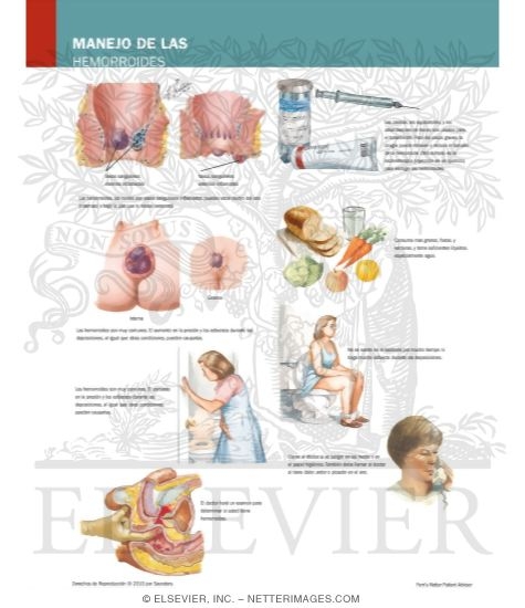 Managing Your Hemorrhoids