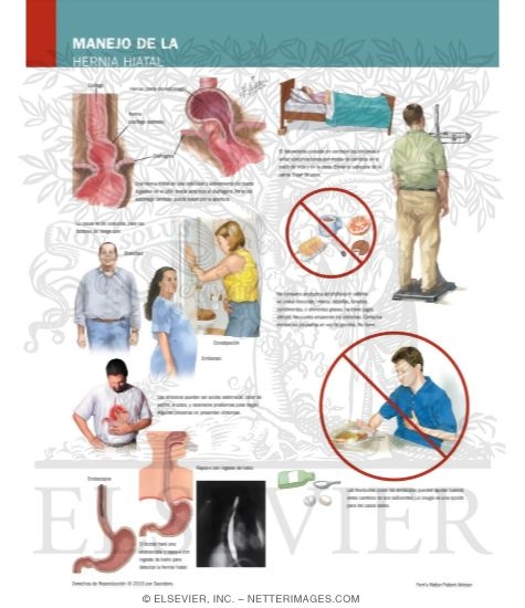 Managing Your Hiatal Hernia
