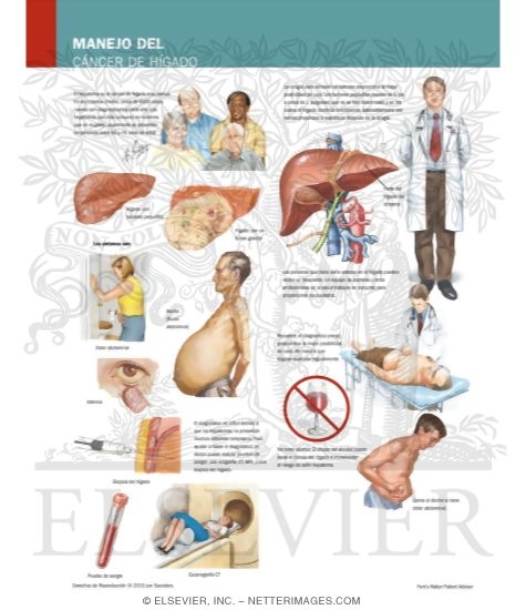 Managing Your Liver Cancer