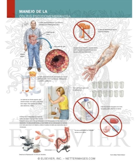 Watermarked preview of labeled image: Managing Your Pseudomembranous Colitis