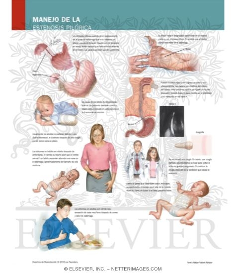 Watermarked preview of labeled image: Managing Your Pyloric Stenosis