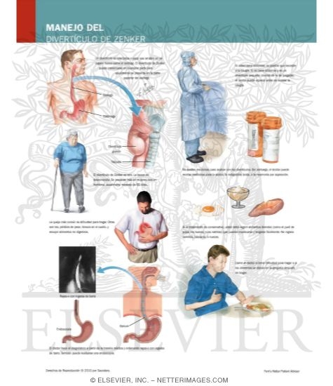 Watermarked preview of labeled image: Managing Your Zenker's Diverticulum