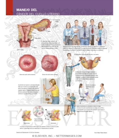 Watermarked preview of labeled image: Managing Your Cervical Cancer