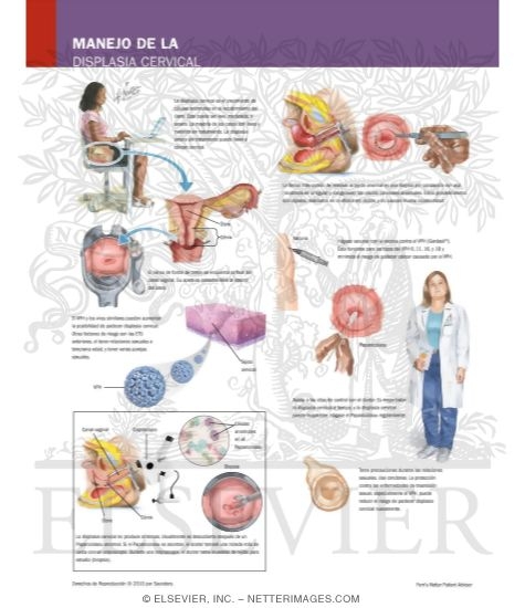 Managing Your Cervical Dysplasia