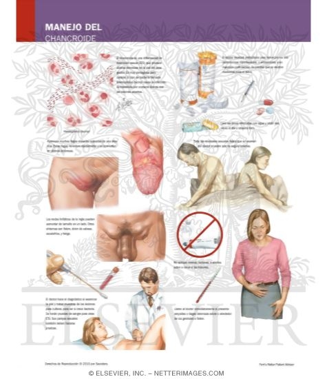 Watermarked preview of labeled image: Managing Your Chancroid