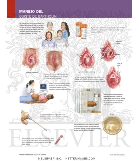 Managing Your Bartholin Cyst