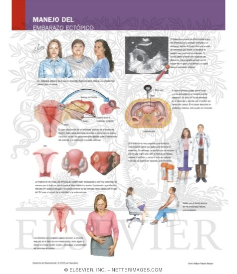 Managing Your Ectopic Pregnancy